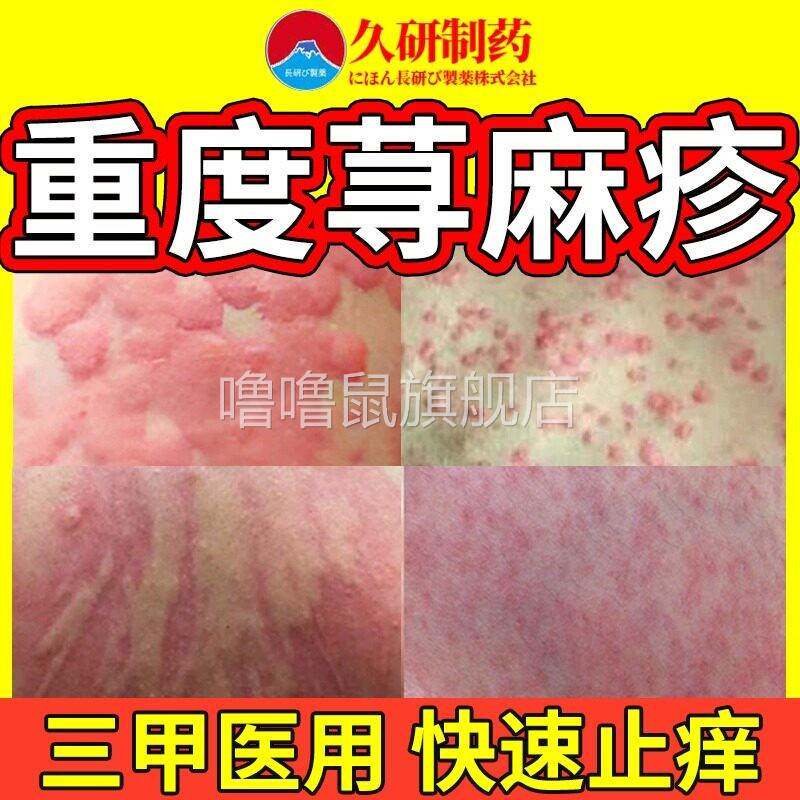 噜噜鼠正品寻荨麻疹过敏止断急性丘疹性胆碱性荨麻疹进口根提高免