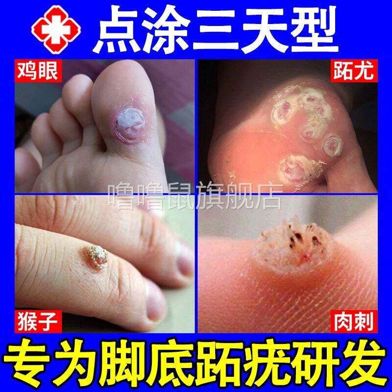 噜噜鼠正品疣瘊净去尤猴子肉粒疙瘩一抹无忧灵除扁平跖疣去除神器
