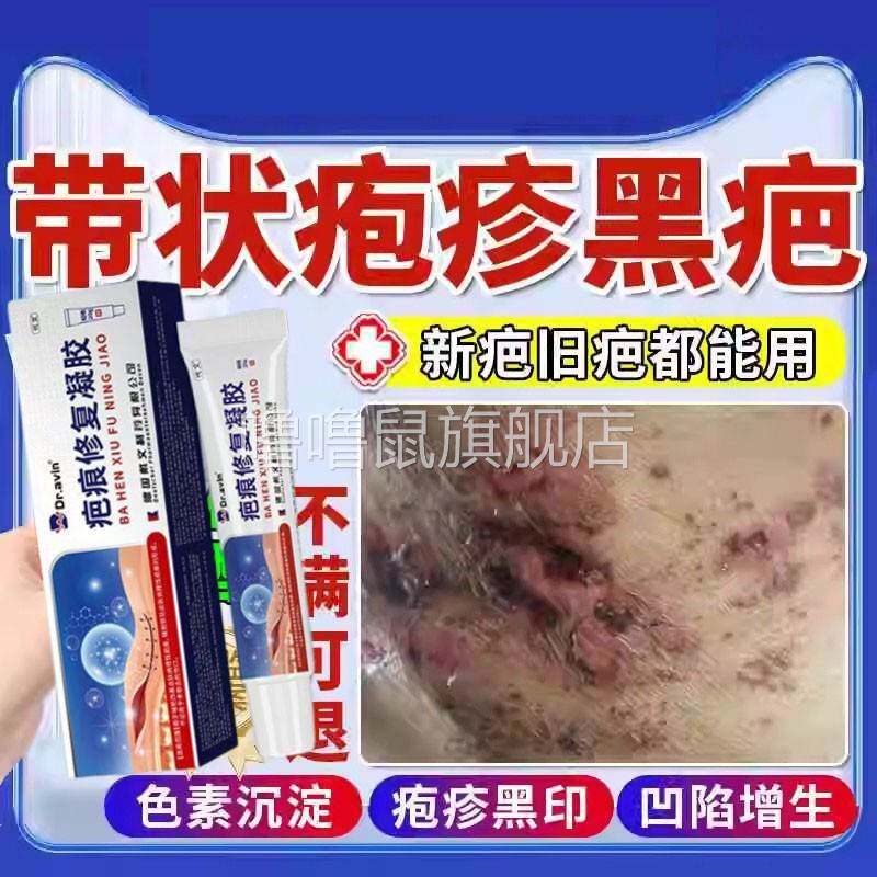 噜噜鼠正品带状疱疹过后祛疤痕修复去除病毒黑色素印子脸上药房同