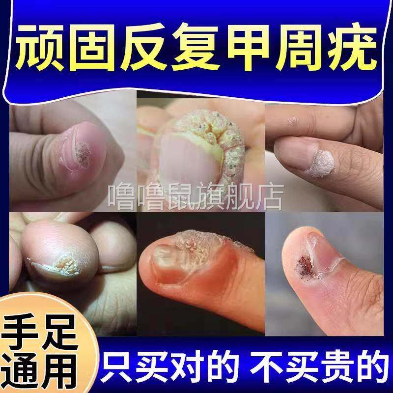 噜噜鼠正品甲周疣甲下疣专用去儿童手指长疣寻常疣瘊子祛除去除硬