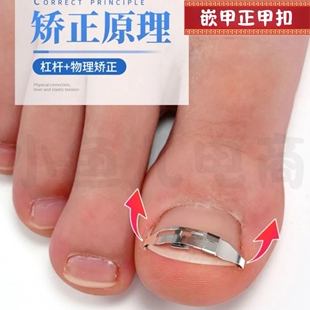 专用甲沟炎矫正器脚趾甲沟扎肉脚指甲修正器指甲贴纠正指甲效正器