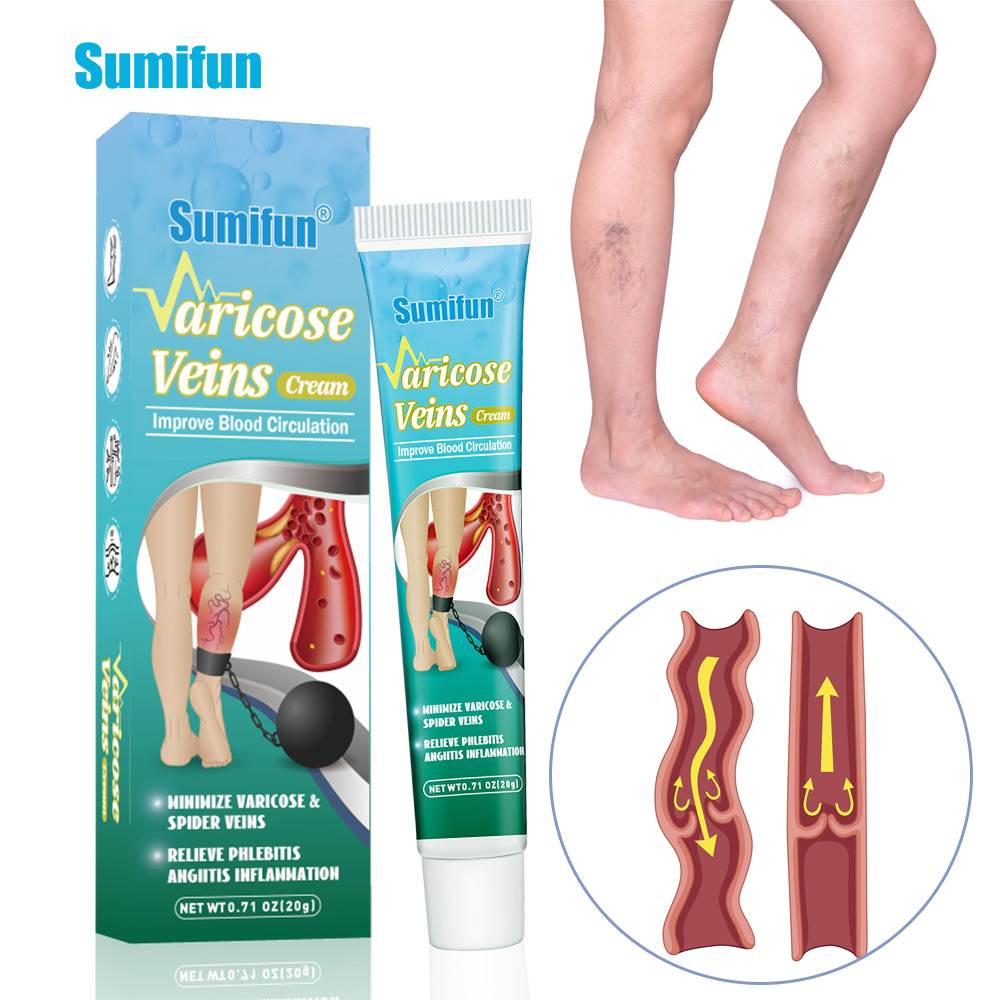 20G Sumifun Varicose Veins Treatment Cream Promotes Blood Ci