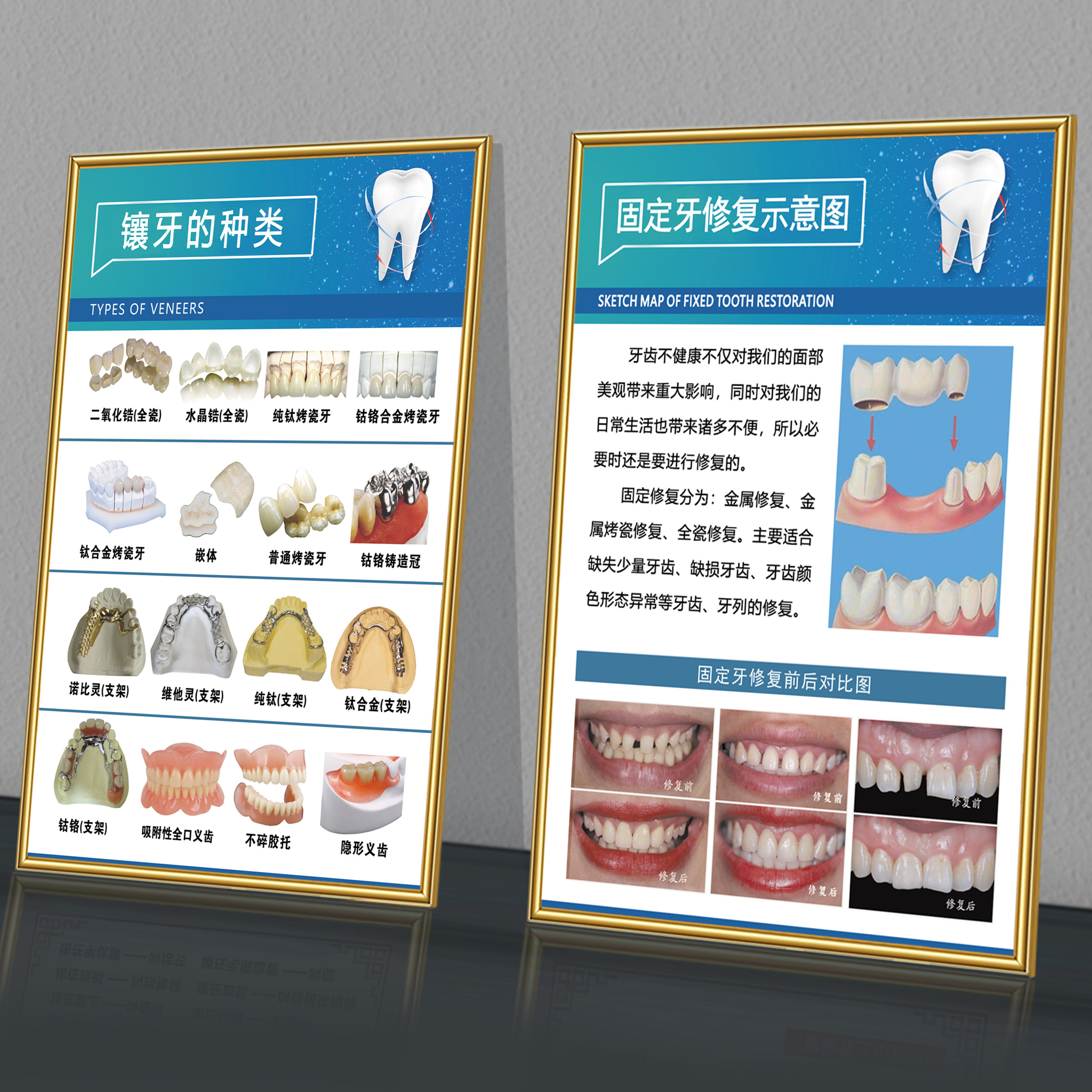 牙科挂图口腔知识宣传画烤瓷牙解剖牙齿海报口腔诊所装饰挂画贴纸
