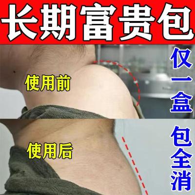 富贵包消除神器修复颈部大椎鼓包肩颈脖子不适酸痛祛鼓包堵塞药膏