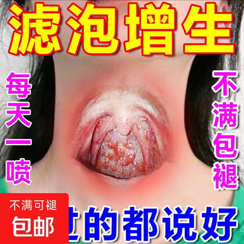 舌根滤泡增生咽后壁慢性咽喉咙干咳扁桃体喉炎发言有异物感疼痛贴