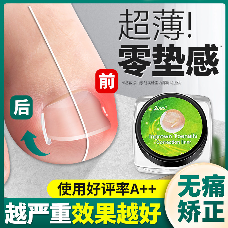 速发甲器娇正神甲炎脚指甲纠正沟嵌甲器专用隔离填充垫片趾器正甲