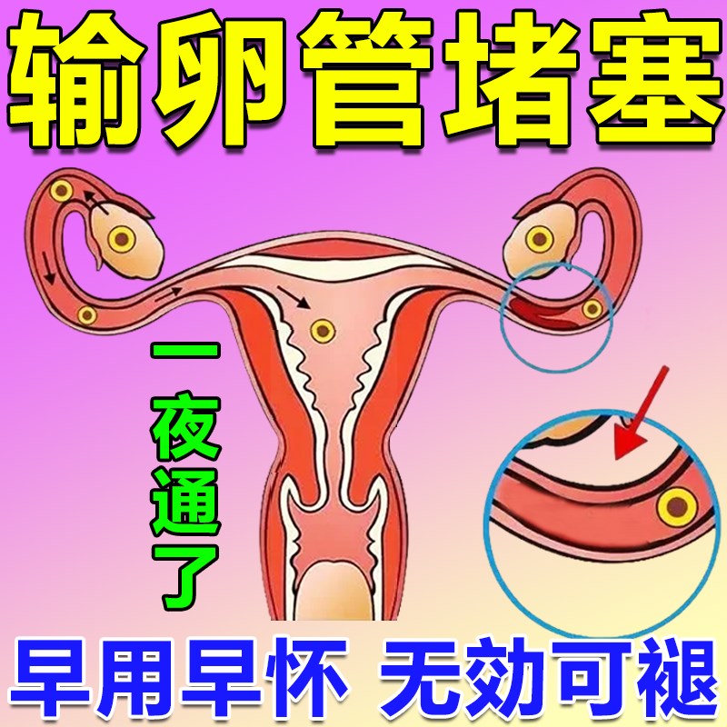 速发备连神器排卵管不堵通畅塞卵巢寒多囊宫腔粘孕积水肚脐贴热敷