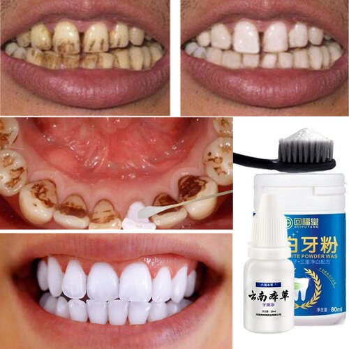 Teeth Whitening Oral Teeth Care Tooth Cleaning WhiteningTool
