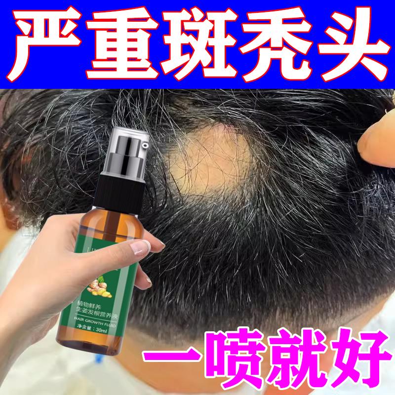儿童斑秃生发液秃头掉发地中海防脱育增发激活毛囊发际线专用喷剂