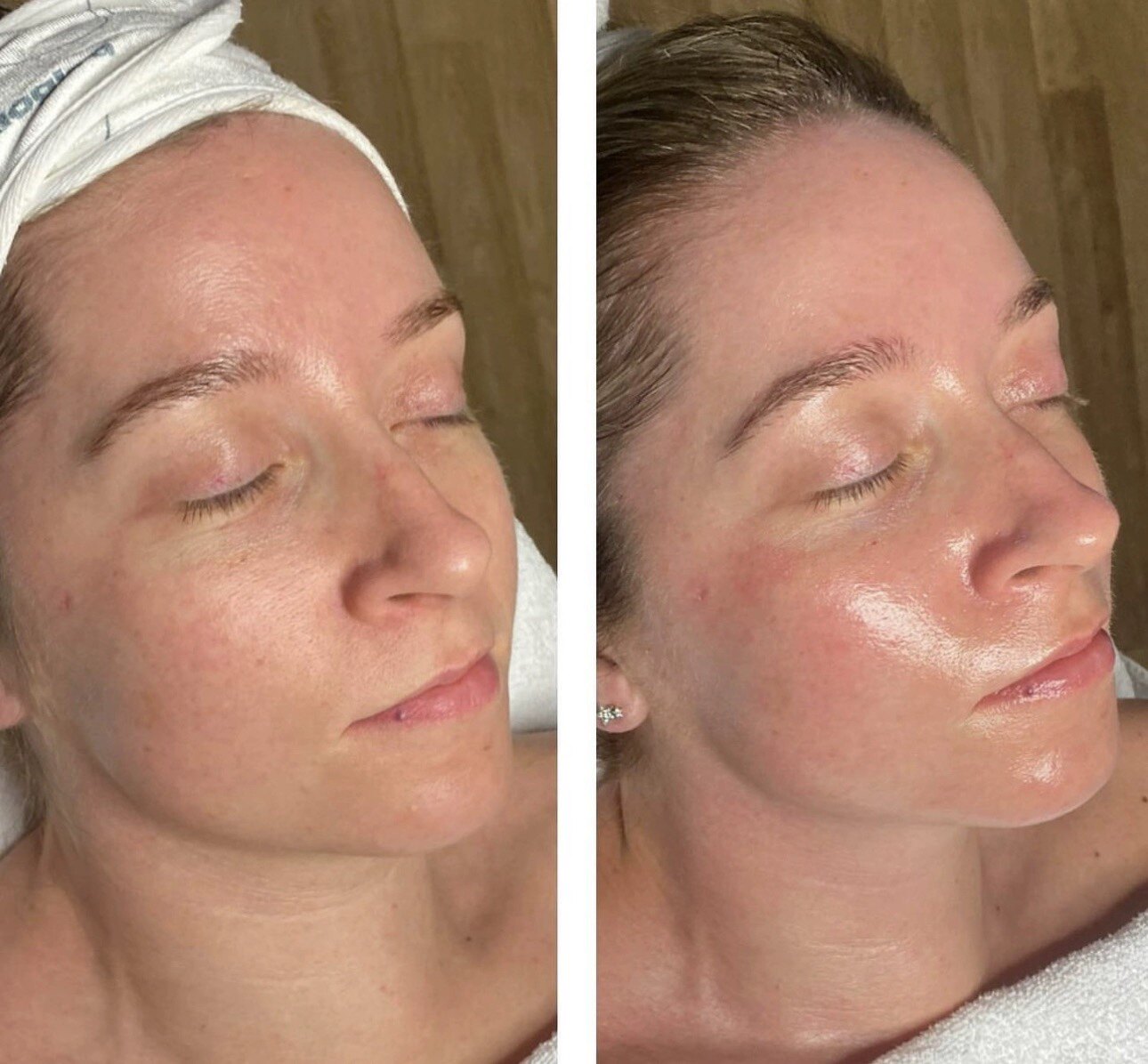 德国AE整外 高山雪绒花组织提取修护 屏障 紧致 亮白 面膜10片