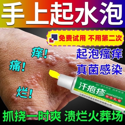 手上起小水泡汗泡疱止痒中药抑菌鹅掌风真菌感染手气湿痒疹专用膏