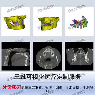 口腔CBCT医学影像三维重建DCM STL NII术前规划标注训练定制服务
