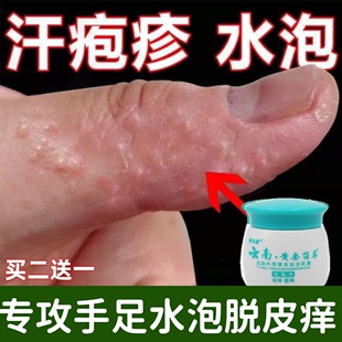 汗疹手痒起水泡手指手掌手足脱皮干裂湿气疱止痒小水泡百草止痒膏