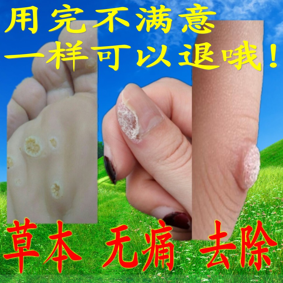 跖疣瘊子无痛去疣灵去除儿童成人足部刺猴肉刺趾疣净鸡眼膏甲周疣