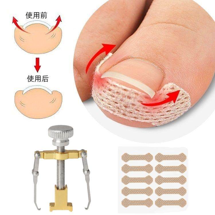 嵌甲矫正器脚趾甲翘修脚套装