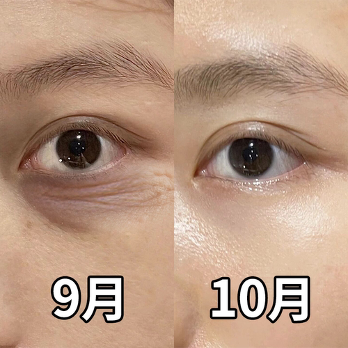 无效包退告别黑眼圈跟泪沟说拜拜