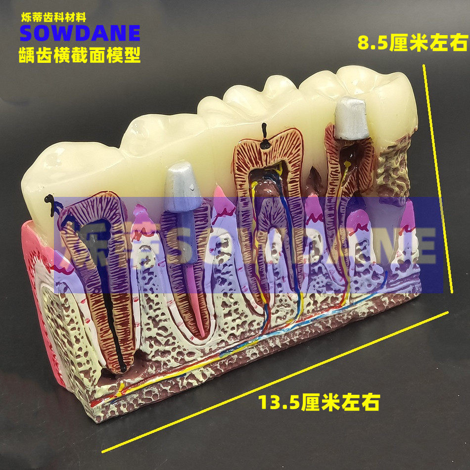牙科口腔4倍龋齿病理解剖 横截面根管充填及牙神经展示 沟通模型