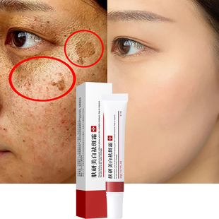 Whitening Freckle Cream Remove Melasma Cream Remove Dark Spo