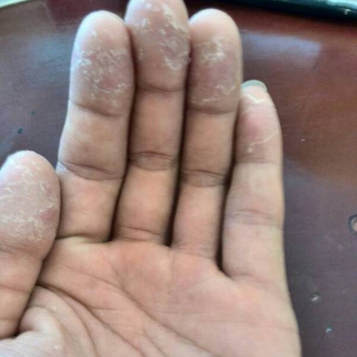 抖音同款手气手脱皮膏水泡手掌开裂干裂手蜕皮修复霜手上起皮爆皮