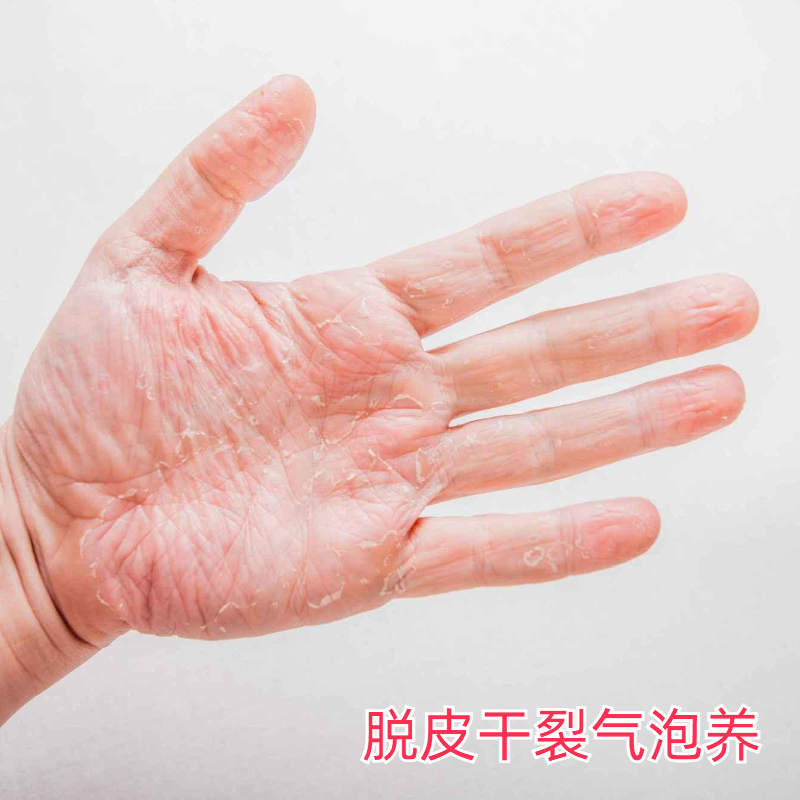 小孩手指头蜕皮手脱皮水泡手掌干燥心脚上起皮止痒脚底掉皮护手霜