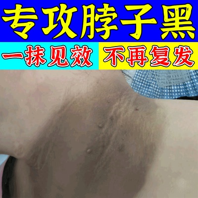 脖子黑棘皮病去除黑脖子洗不干净黑色素沉淀肥胖症深层清洁白神器