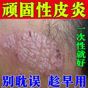 神经性皮炎膏顽固无激素治皮肤剧烈瘙痒真菌感染外用脖子上皮炎膏