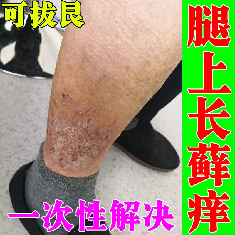 天热小腿长藓痒神经性皮炎去湿痒疹真菌感染慢性苔藓瘙痒止痒膏