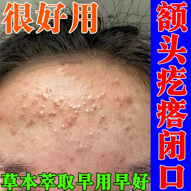 额头闭口粉刺的克星脸上起小疙瘩皮肤消毒护理（消）