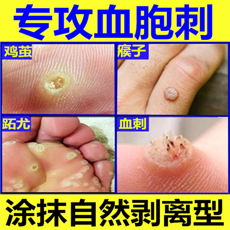 猴子去除神器血泡刺贴血胞刺去除膏贴刺猴子跖尤去除专用膏脚钉