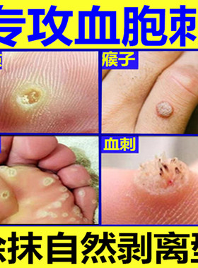 猴子去除神器血泡刺贴血胞刺去除膏贴刺猴子跖尤去除专用膏脚钉