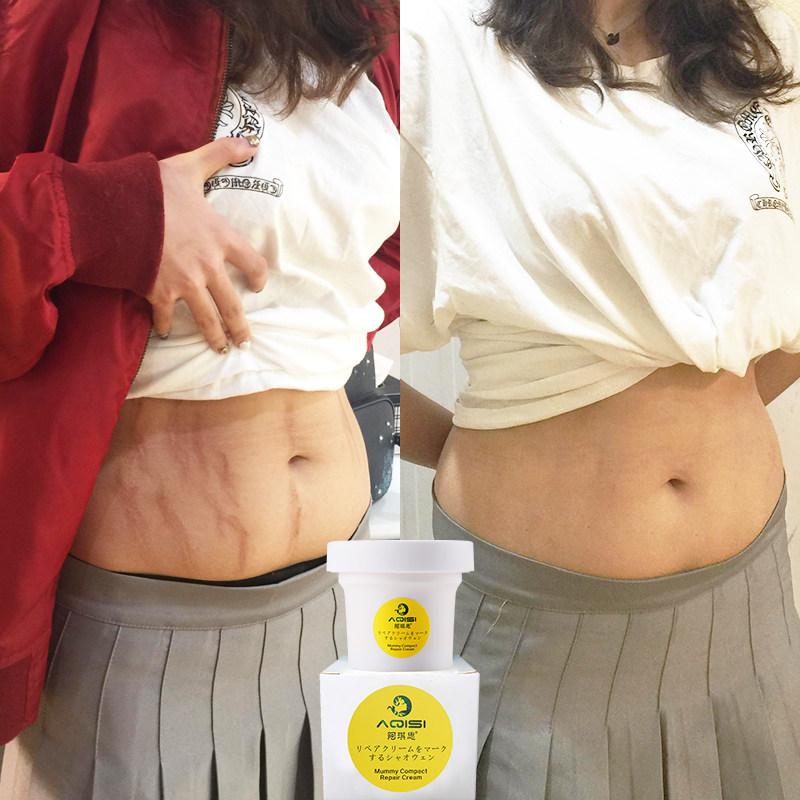 [确认过眼神 爱的就是你妊娠纹护理]拍2发3 拍3发5 产后妊娠纹修复霜月销量146件仅售89元