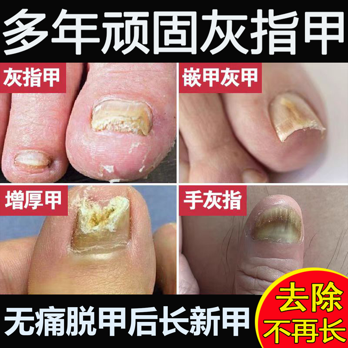 灰指甲无痛脱甲膏草本抑菌液快速脱甲精油甲沟炎脚指甲嵌甲软化剂