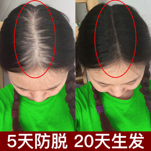 爆卖 13天猛涨 7天止脱28天密发 防脱育发还你发量 男女通用 2发3