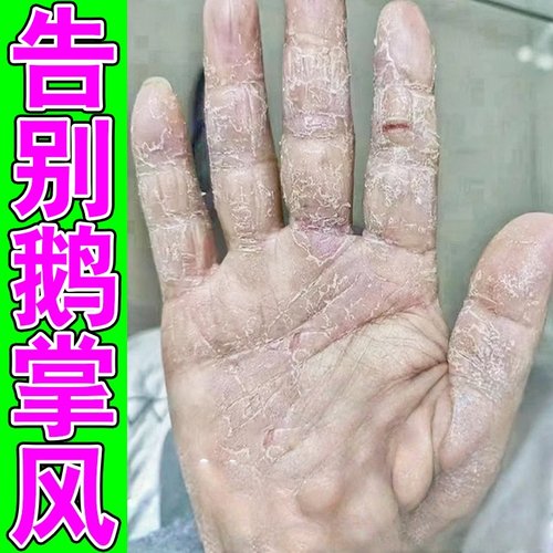 鹅掌风专用膏手指头干燥裂口手掌心脱皮掉皮角化型湿痒诊乳膏
