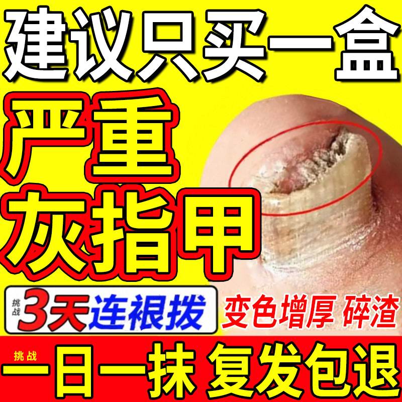 【自营】灰指甲特效药根治第一名专用药正品官方旗舰店亮治疗1甲