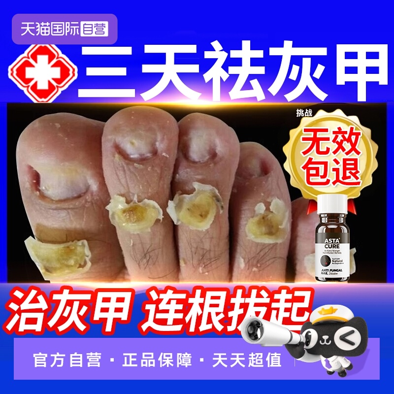 【自营】灰指甲特效药根治第一名专用药正品官方旗舰店亮治疗灰甲