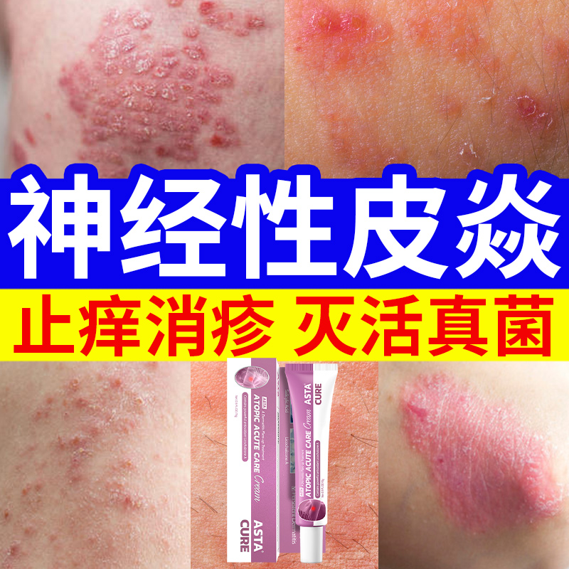 【自营】神经性皮炎湿疹药膏止痒去根特效药皮肤瘙痒外用顽固皮炎