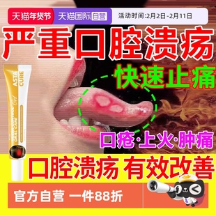 口腔溃疡专用特效膏贴西瓜霜喷剂药舌头溃疡散口疮凝胶