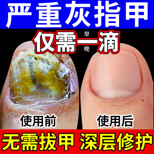 【自营】灰指甲特效药根治第一名专用药正品官方旗舰店亮治疗灰甲