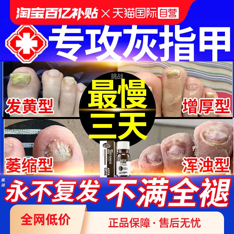 【自营】灰指甲特效药根治第一名专用药正品官方旗舰店亮治疗灰甲