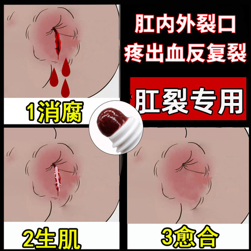 木子潼草本肛裂愈合膏儿童男女哺乳期产后软外用