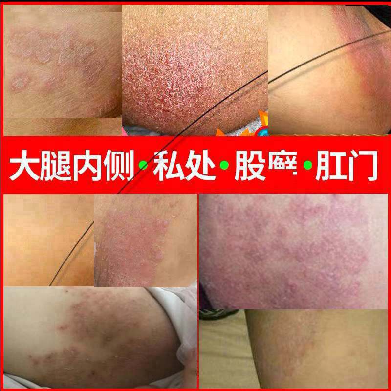 肤藓霜草本抑菌乳膏私处皮肤瘙痒