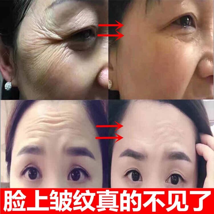 祛皱纹抗去衰老除皱抬头纹除填充法令纹去鱼尾纹提拉紧致男女通用