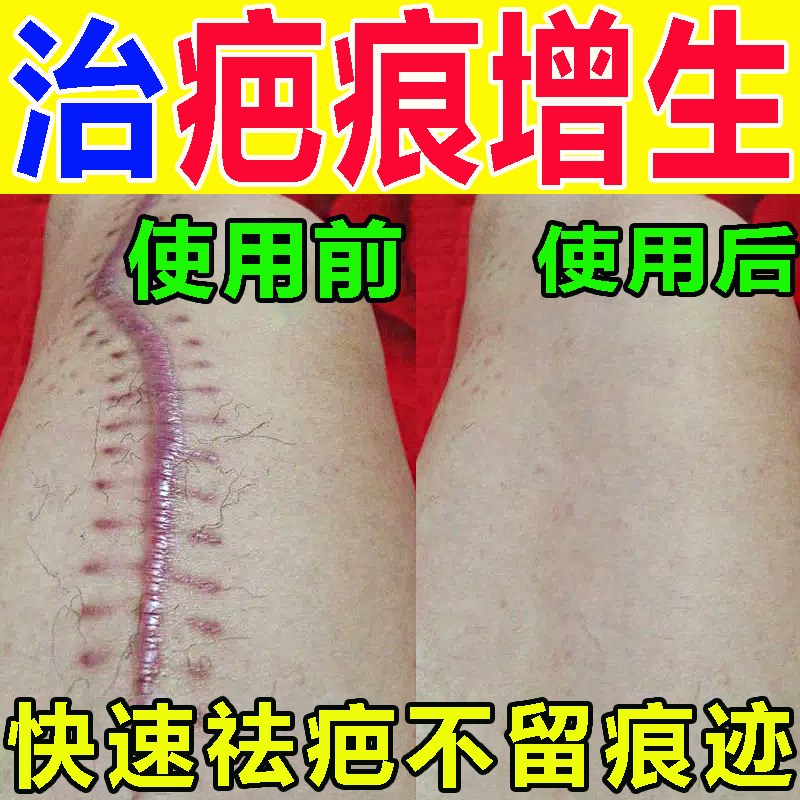 疤痕增生凸起去除胸前瘢痕疙瘩软化针修复油烫伤疤体质痒专用膏