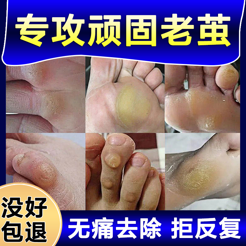 老茧去除软化剂去手脚上的茧子根