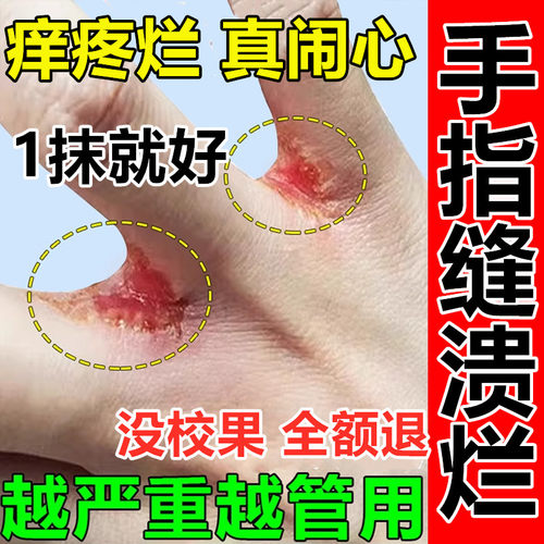手指缝溃烂药膏开裂手气退皮止痒脱皮鹅掌风专用手癣膏药真菌感染