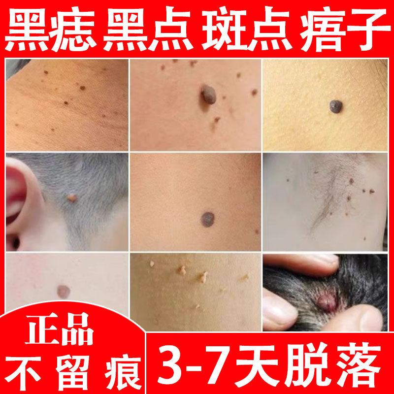 点痣膏无痕去除脸部黑痣点痦子取痣专用点痣笔非药水神器仪正品