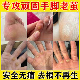 去除老茧脚茧手脚趾脚底死皮关节茧软化剂祛脚垫的药治胼胝神器根