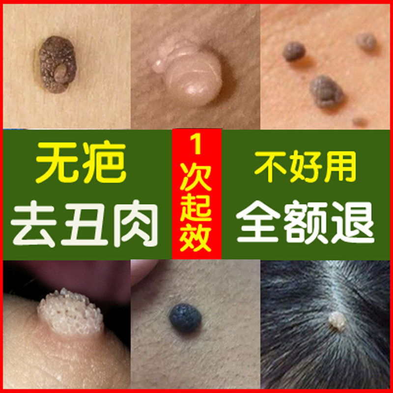 点脖子上长的肉瘤丝状去除膏痦子祛肉揪揪