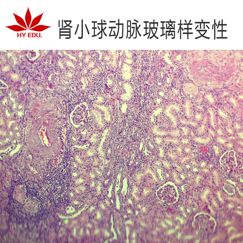 肾小球动脉玻璃样生物切片红叶